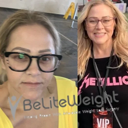 Weight Loss Surgery Gastric Sleeve before and after